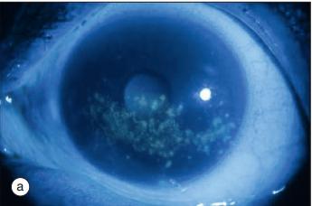 干燥综合症最怕的三种食物,干燥综合症的8大临床特征