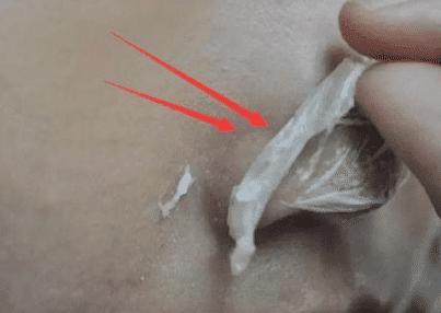 去黑头小妙招学生党草莓鼻,祛黑头3步轻松搞定顽固黑头