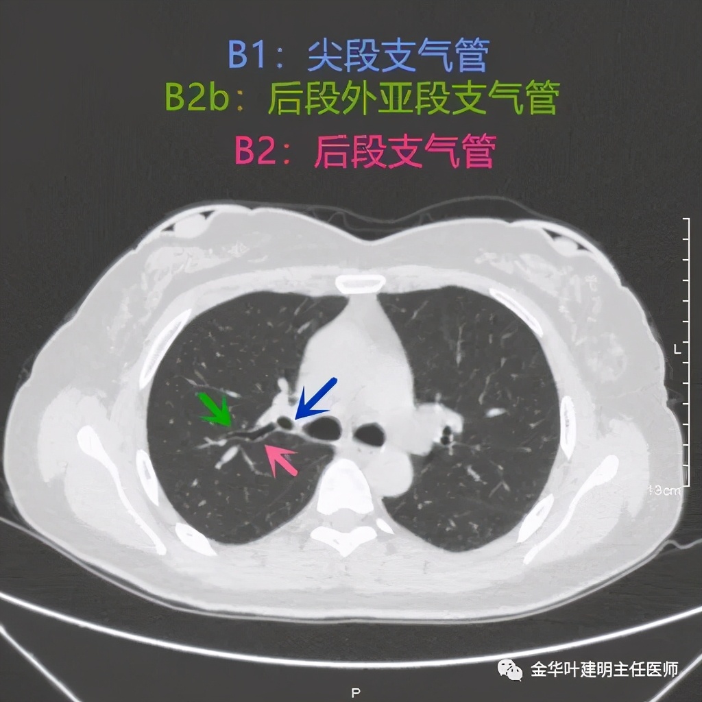 左肺上叶在ct影像上怎么看,平扫ct可以看出肺肿瘤的变化吗