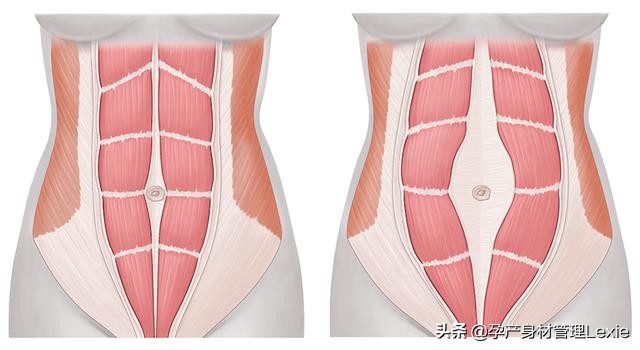 产后腹直肌分离4指能恢复吗,产后20年腹直肌分离2指还能恢复吗