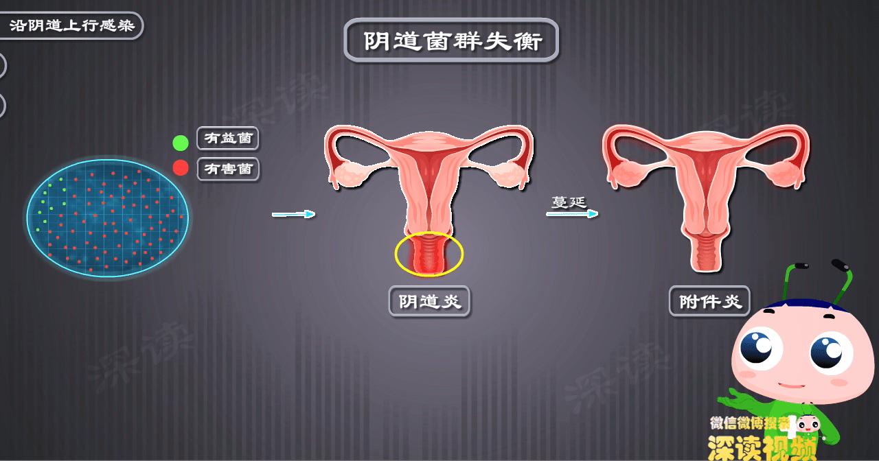 附件炎怎么造成的,人流后附件炎