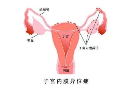 女性的腰痛要警惕四种原因,女性左侧腰痛需警惕3种妇科疾病