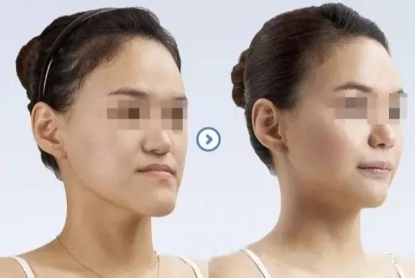 正畸日记补牙,正畸刚戴上牙套的不适应有哪些