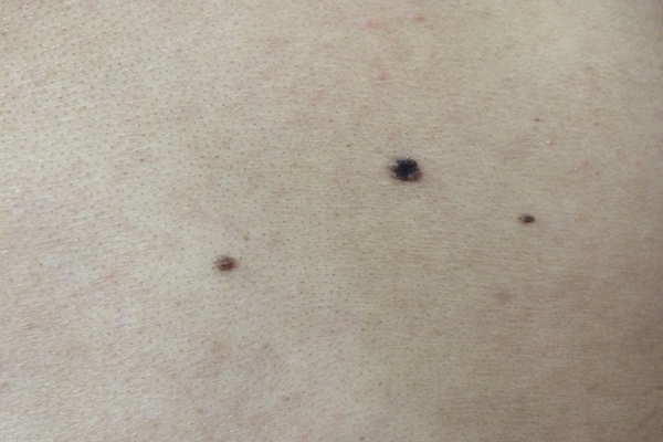 人身体上的痣有哪些忌宜,痣有好痣和坏痣的说法吗