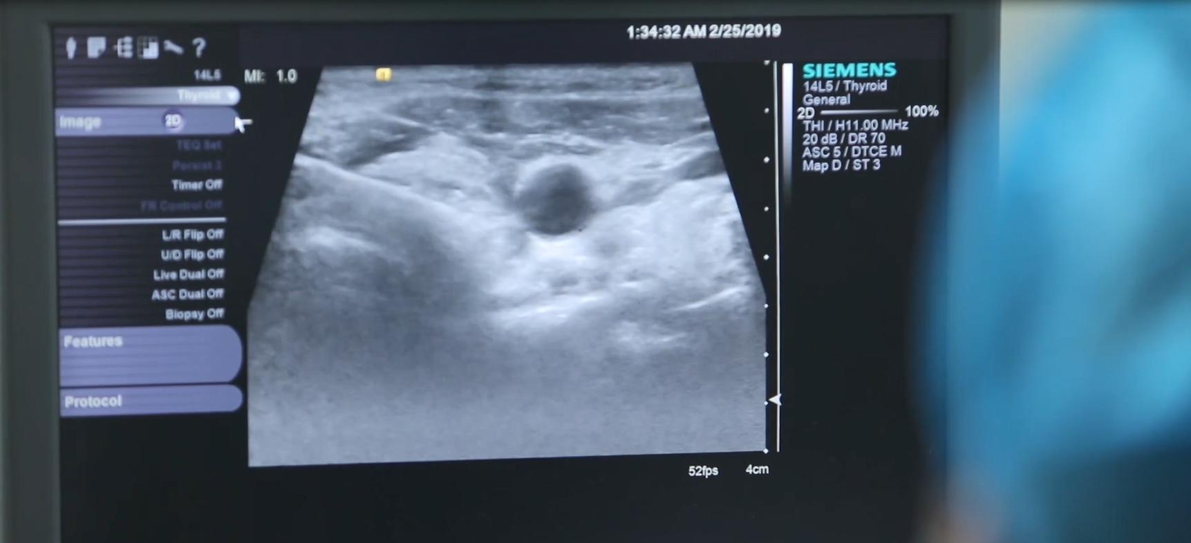 甲亢致人死亡,甲亢实际案例