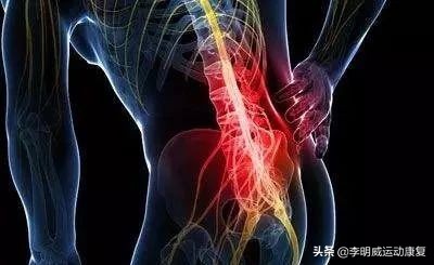 腰痛的最快的恢复办法,腰痛腰间盘突出自行康复