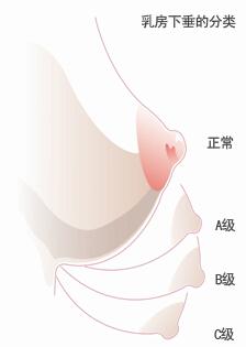 乳房下垂矫正方法有哪些,解决乳房下垂有什么方法