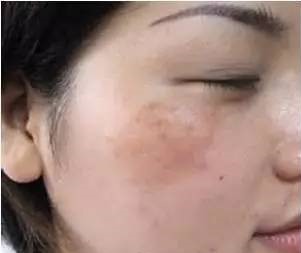 褐斑是什么原因造成的,褐斑的原因及治疗方法