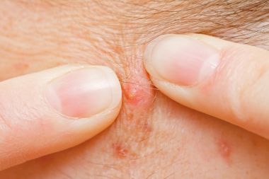 怎么拯救毛孔粗大堵塞,如何拯救已经粗大的毛孔