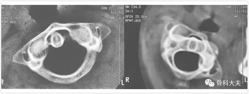 脖子突然往一边歪是怎么回事,孩子脖子突然歪了怎样矫正