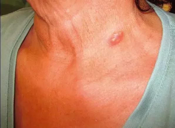 28岁小伙癫痫16年，脑子被虫吃了！竟因爸爸给他吃这个“大补”