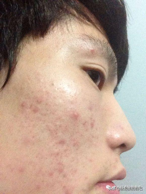 痘印长期不消怎么办,痘印反复消不下去怎么办