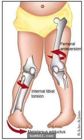 小孩喜欢勾腿是为什么,幼儿罗圈腿会自己好吗