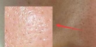 痘痘防止复发的方法是什么,反复长痘怎么解决改善痘痘肌