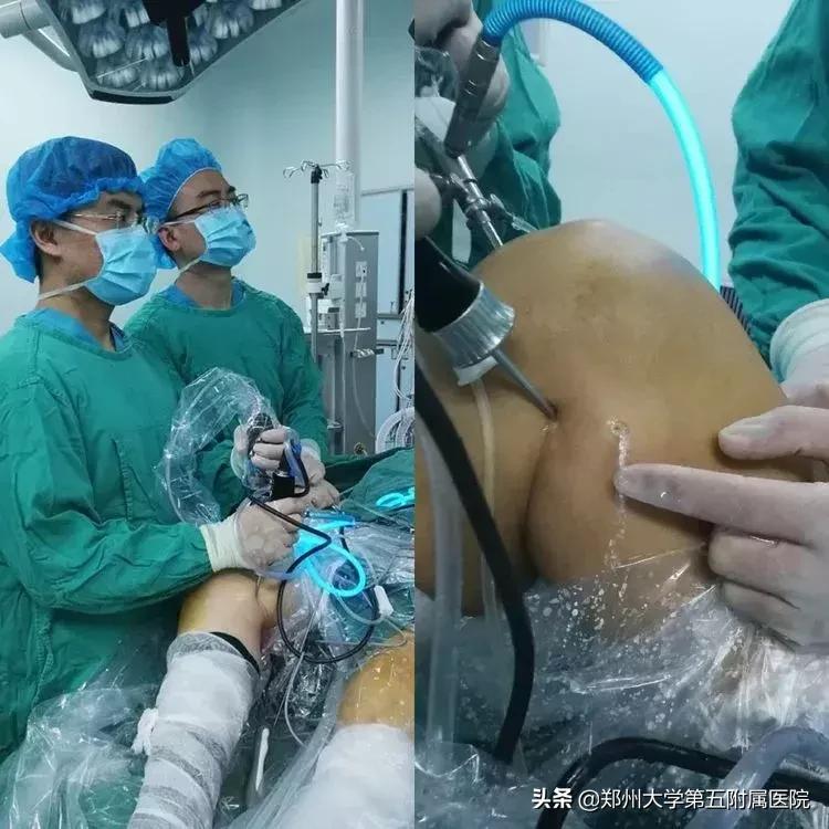 腘窝囊肿用针灸和蜡疗能治好吗,腘窝囊肿手术切口如何选择