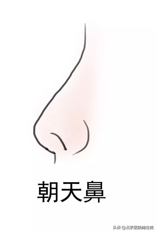 天生鼻型不完美怎么办呢,八种鼻型不佳图片