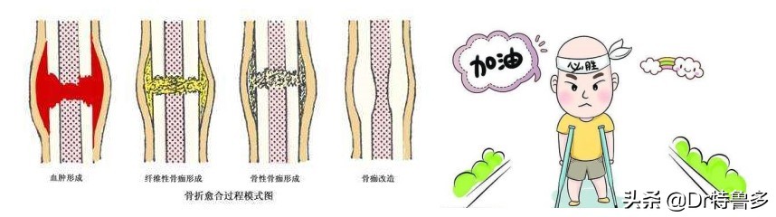 骨折了不长、长得慢怎么办？试试冲击波治疗吧