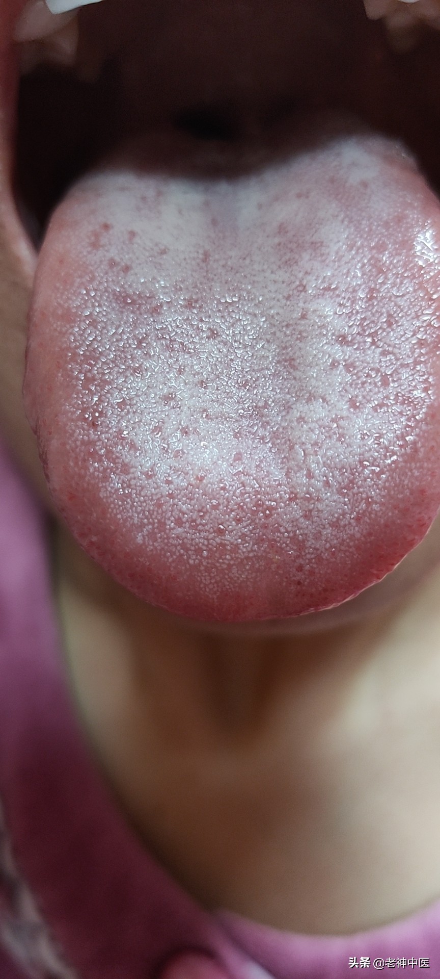 顽固性*麻疹荨**，治疗了几年，满满的眼泪，快试试中医中药