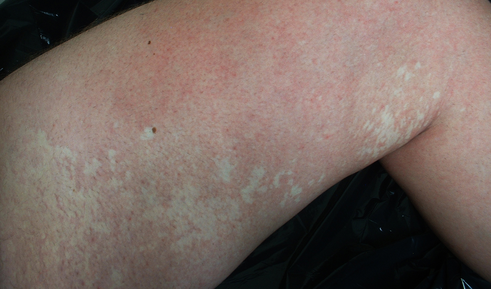 乳红色的白斑是不是白癜风,医生说我的白斑是白癜风能信吗