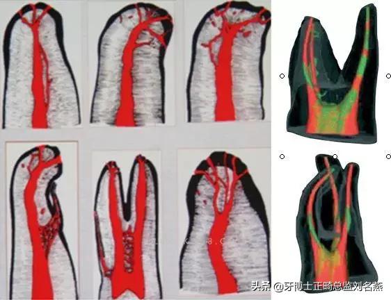 根管治疗难点与解决方案,根管治疗牢固吗