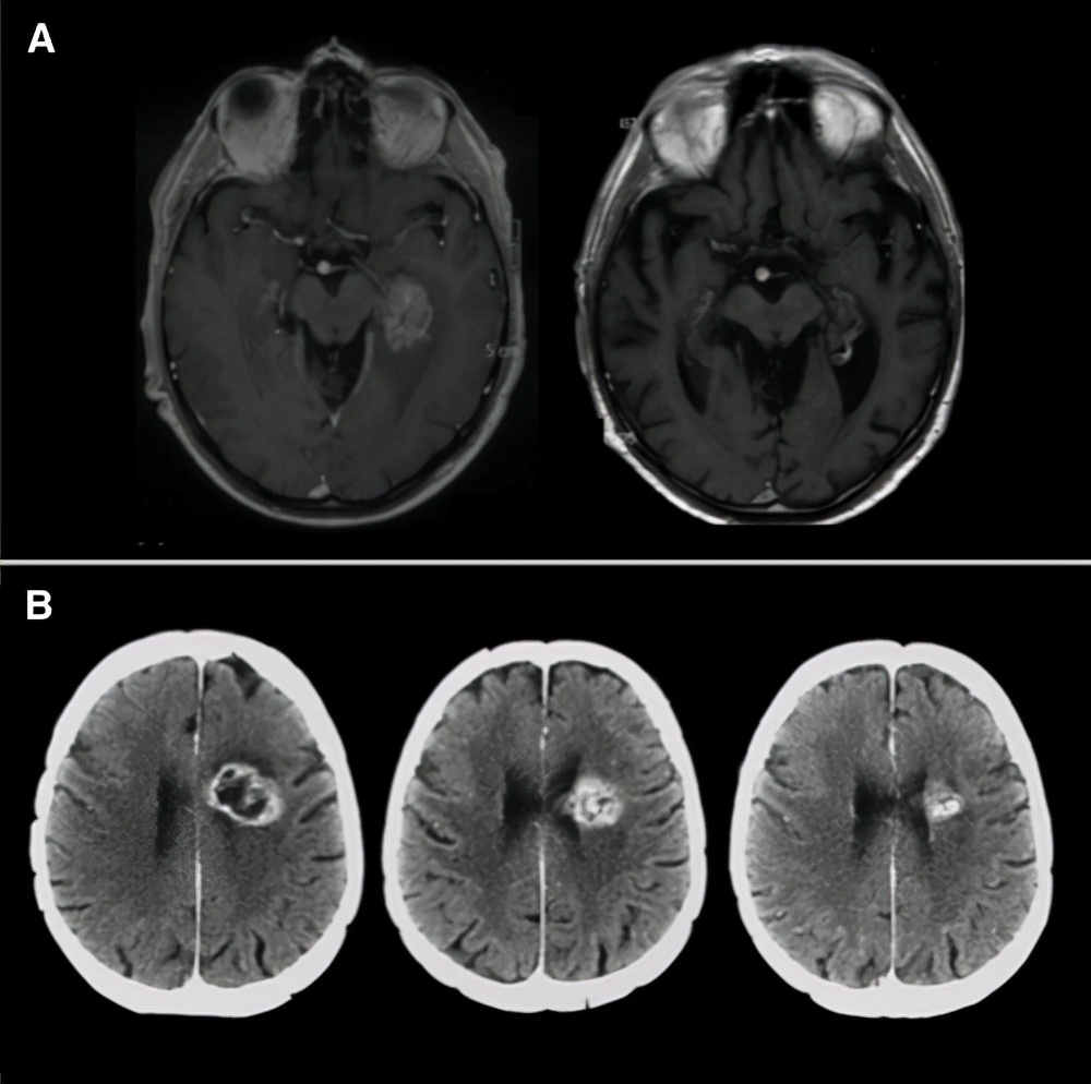 82岁胶质瘤保守治疗病情发展过程,高龄胶质瘤能用鸡尾酒疗法吗
