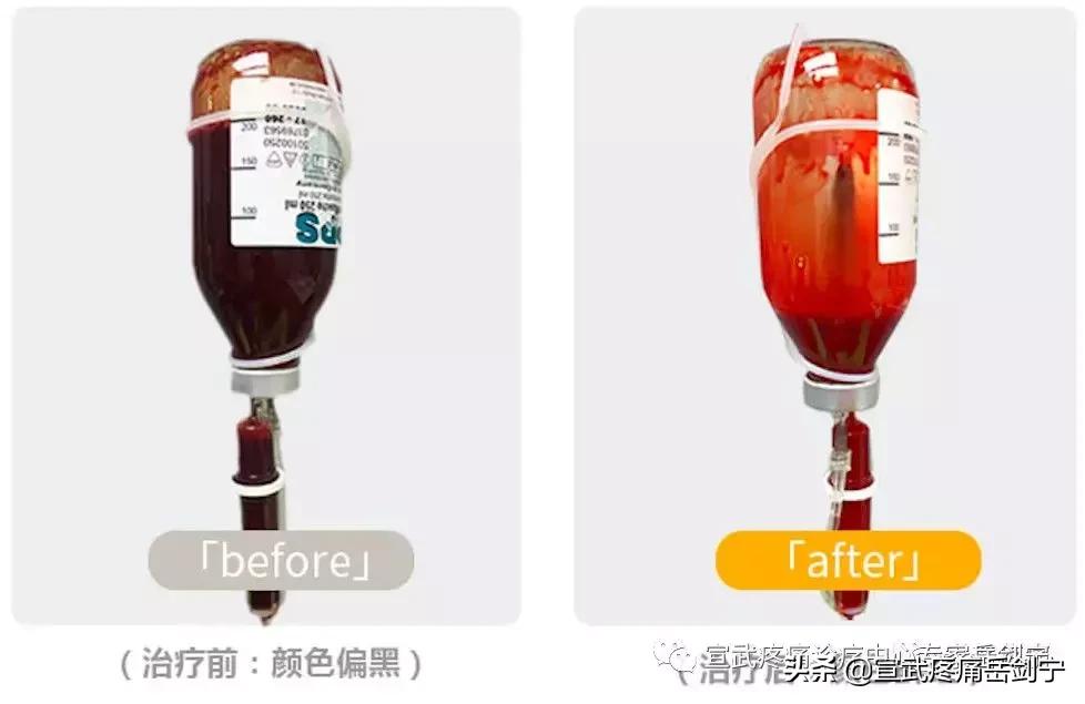 自体血液治疗,自己的血可以治病吗