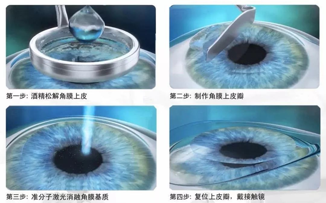 800度近视做飞秒手术还是晶体植入,800度的近视怎么治