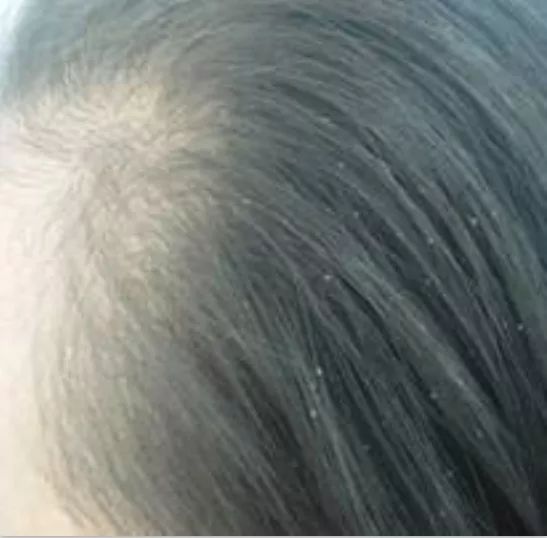 12岁女孩头皮屑产生得快怎么办,13岁女孩头皮屑多是什么原因