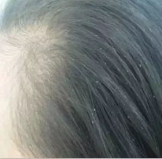 12岁女孩头皮屑多到吓人！竟是这个习惯造成的！