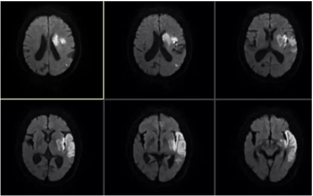 颈动脉狭窄介入治疗的后遗症,颈动脉闭塞介入手术是局麻吗