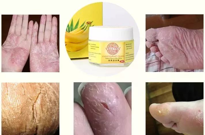 手上冻疮干裂怎么办,手脚冻脸上冻疮三天快速消除