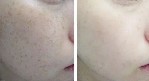 严重痘印晒斑,5个祛斑小妙招淡化晒斑雀斑痘印