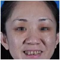 矫正牙齿不给报销吗,牙齿矫正为什么不能纳入医保