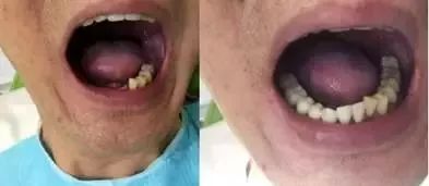 矫正牙齿不给报销吗,牙齿矫正为什么不能纳入医保