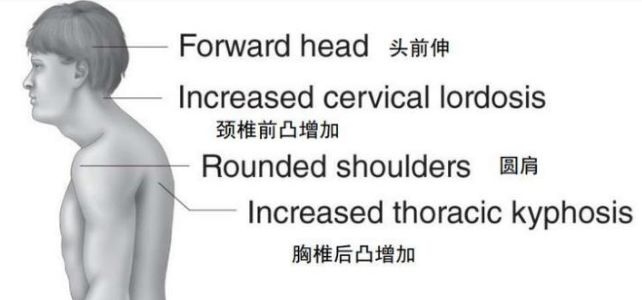 防驼背矫正神器步骤,纠正驼背神器视频