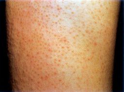 鸡皮肤很严重被嫌弃,一招告别鸡皮肤养成光滑肌