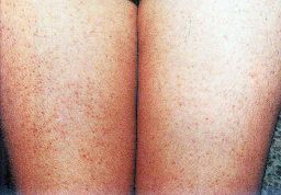 鸡皮肤很严重被嫌弃,一招告别鸡皮肤养成光滑肌