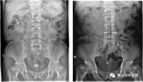 「注意」吓一跳！膀胱结石拳头大，异常信号早警惕
