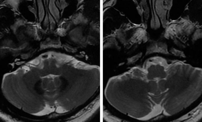 椎动脉起始段狭窄的介入治疗ppt,椎动脉v4段假性动脉瘤介入治疗