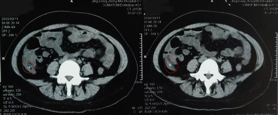 治疗阑尾炎需要手术吗,阑尾炎为什么选择保守治疗呢