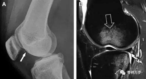 肩关节脱位易漏诊的骨折,放射科容易漏诊的骨折