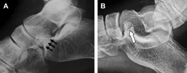 肩关节脱位易漏诊的骨折,放射科容易漏诊的骨折
