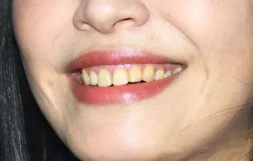 团购|俄罗斯亮白牙膏组合，轻松瓦解多年牙垢，清新口气告别黄牙