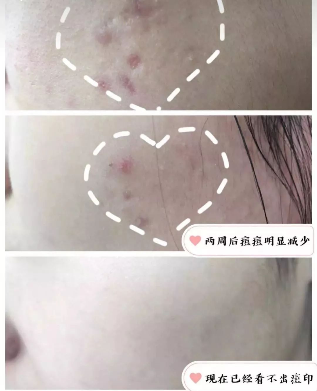 红肿，流脓的万年毒痘一喷全消失？岛国新晋痘肌终结者！彻底祛痘不反复！