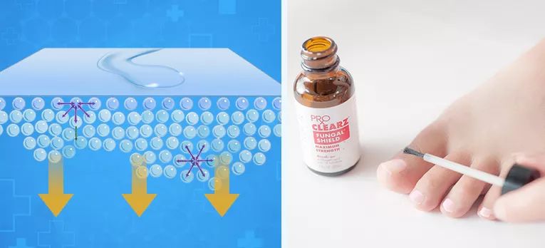 十年灰指甲可以治好吗,一次搞定顽固灰指甲