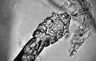 头皮除螨虫神器哪种好用,除头螨头屑小窍门