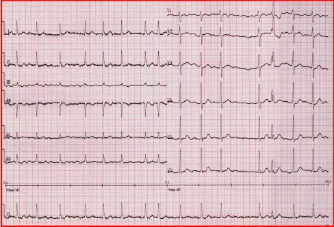 做完消融手术后胸闷憋气,射频消融术后胸闷气短是怎么回事