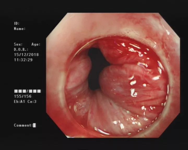 健康｜让你坐立不安的痔疮要这么治……