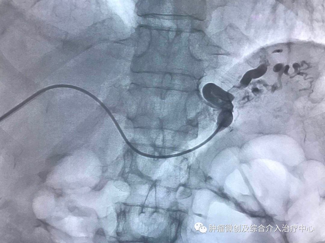 运城市第一医院肿瘤科咋样,运城第一医院治疗肿瘤怎么样