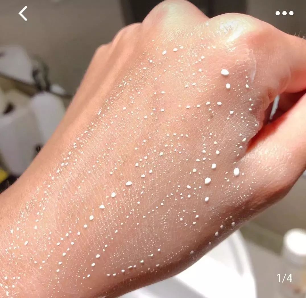 脱发算啥！90后已经开始长“老年斑”了，有人还为此花了10多万！